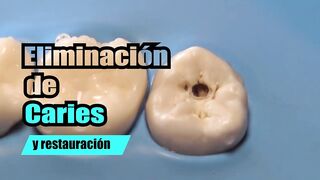 STUNNING cavities being removed in HUGE 4k magnification