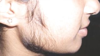 PCOS symptoms, causes, diagnosis & treatment