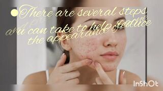 6 skin care tips for acne pron skin ????