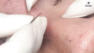 blackheads face  full popping