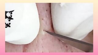 blackheads face point noire