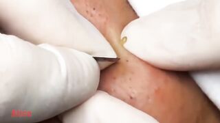 blackheads removal face