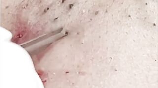 blackheads full