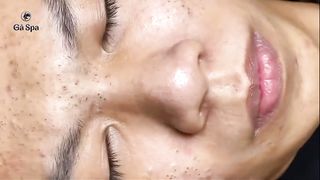 blackheads fullface
