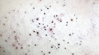 relaxing blackheads make your day