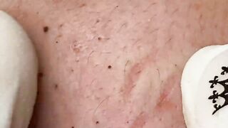 relaxing blackheads