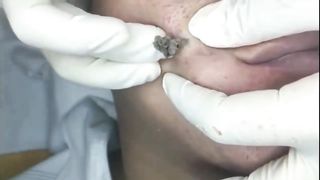 big blackhead  on face
