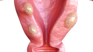 Fibroids Overview