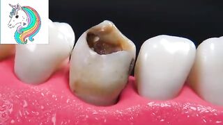 How to repair a damage teeth