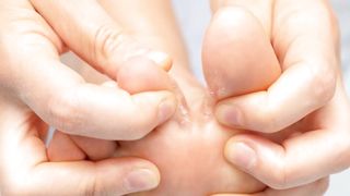 Athlete's foot symptoms, causes, diagnosis & treatment