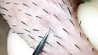 Satisfying process of hair ingrown getting plucked
