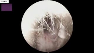 DOCTOR ARE SHOCKED  spider weaving webs inside a man's ear