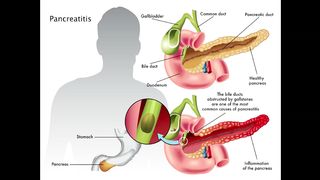 Pancreatitis symptoms, causes, diagnosis & treatment