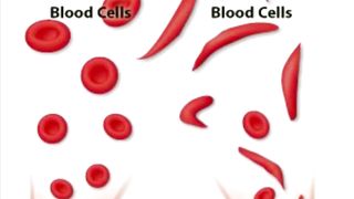 Sickle cell anaemia overview
