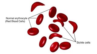 Sickle cell anemia symptoms, causes, diagnosis & treatment