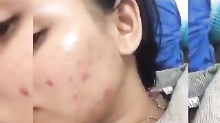 acne face so smooth white