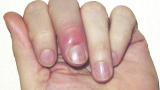 Paronychia symptoms, causes, diagnosis & treatment