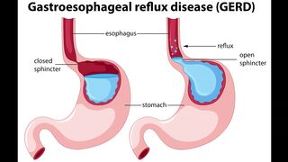 GERD symptoms, causes, diagnosis & treatment