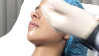 Nanopore Skin Booster | Microneediing