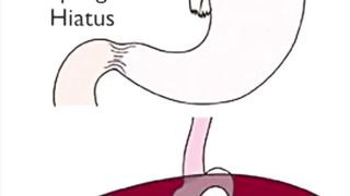 Hiatal Hernia overview