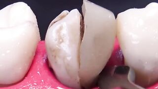 Extracción de diente fracturado en 4K