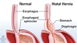 Hiatal Hernia symptoms, causes, diagnosis & treatment