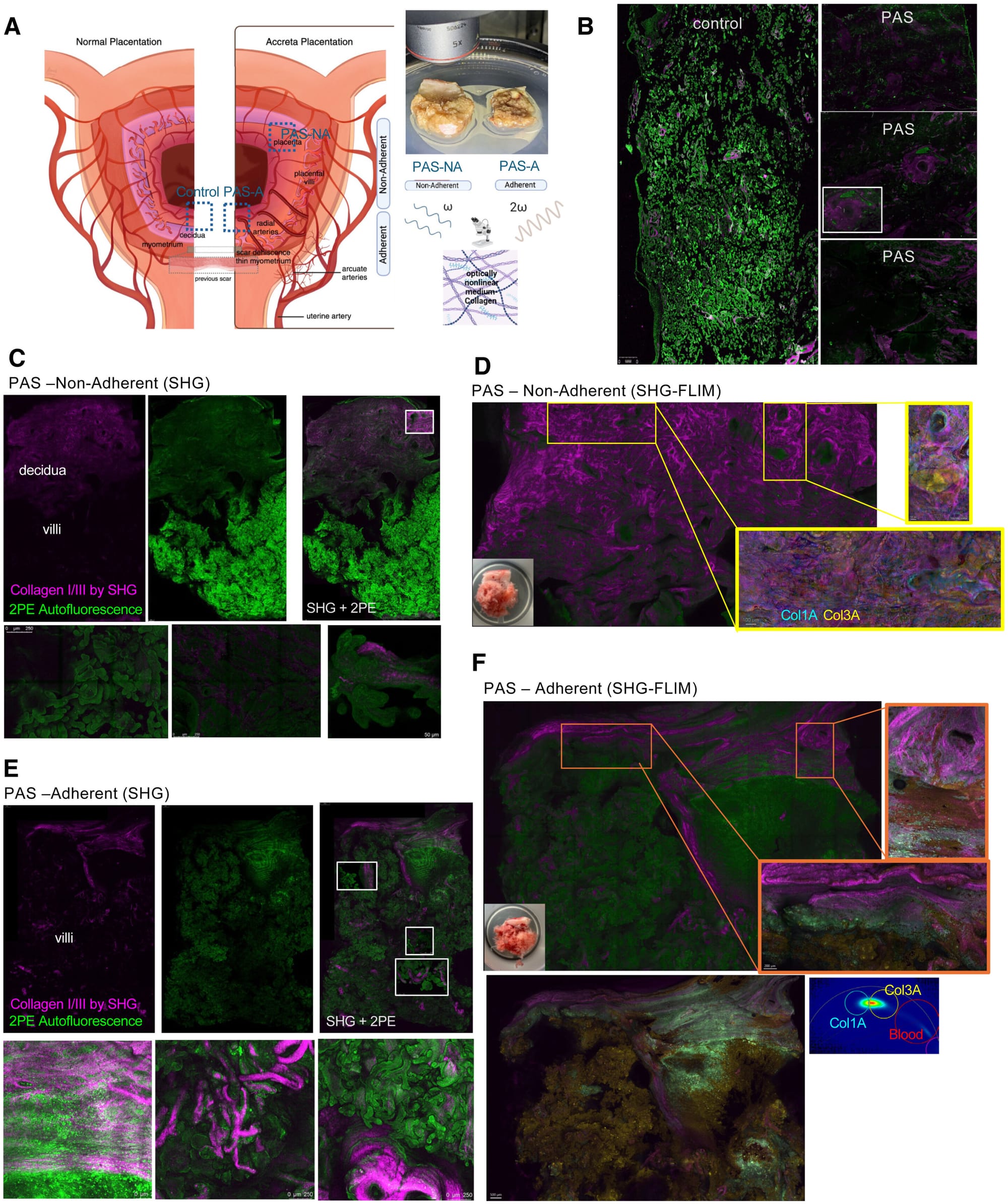 Tangled uterine scar collagen may underlie placenta accreta risk — Scx2.b-cdn.net