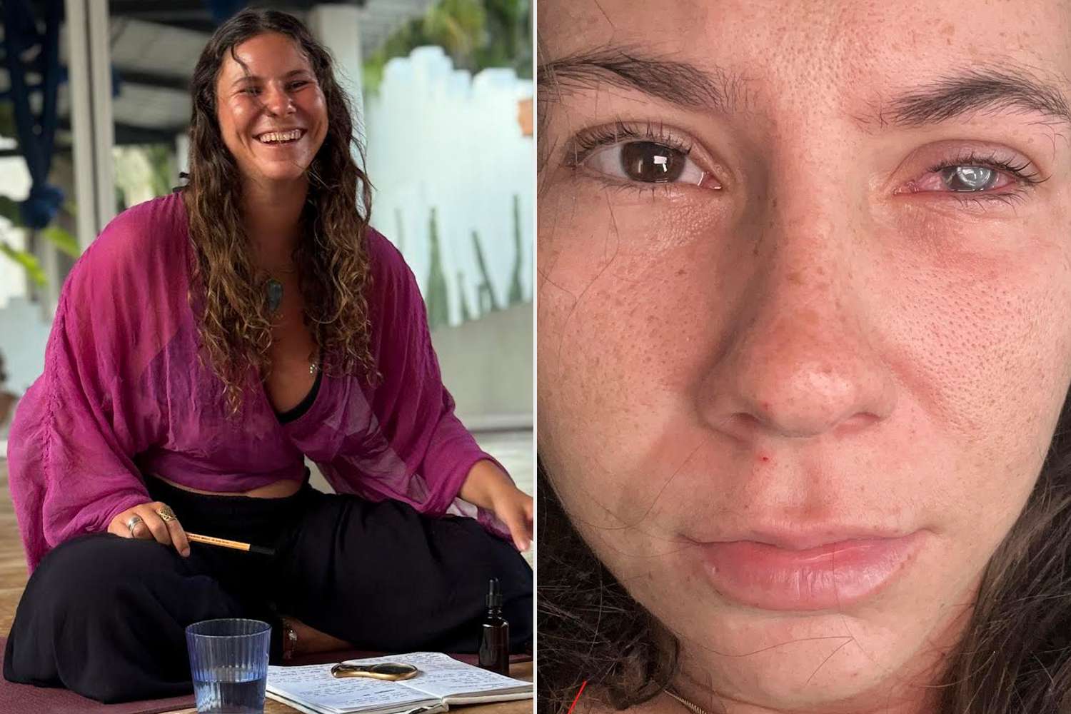 21-year-old wellness coach diagnosed with parasite eating her cornea — People.com