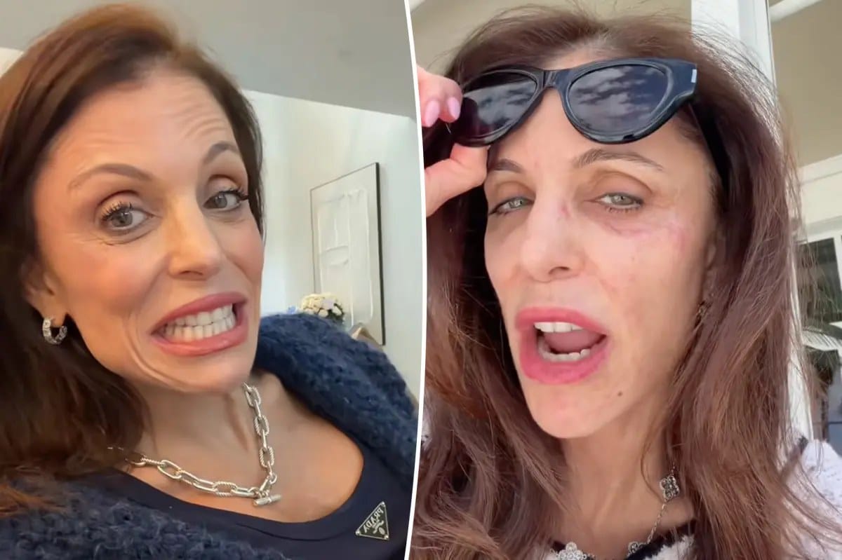 Bethenny Frankel blames St. Barts hotel towels for facial bacterial infection — Pagesix.com
