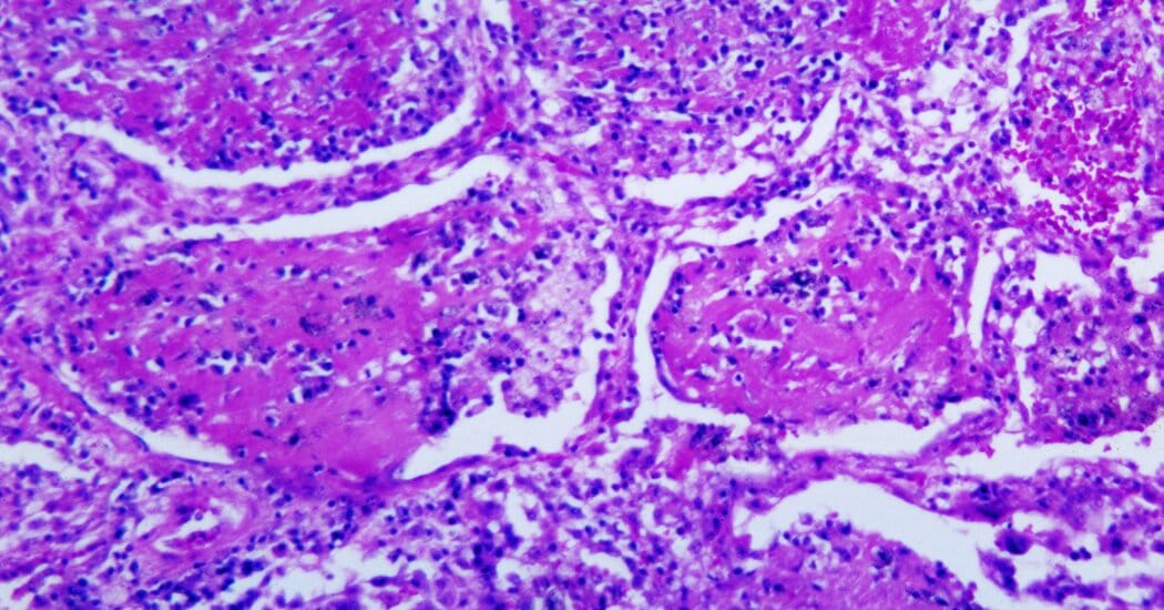 Rare fungal infection sickens dozens in Nashville area; one death under review — Static01.nyt.com