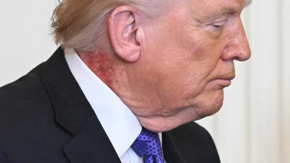 Red rash appears on President Trump’s neck at White House ceremony — Kotaku