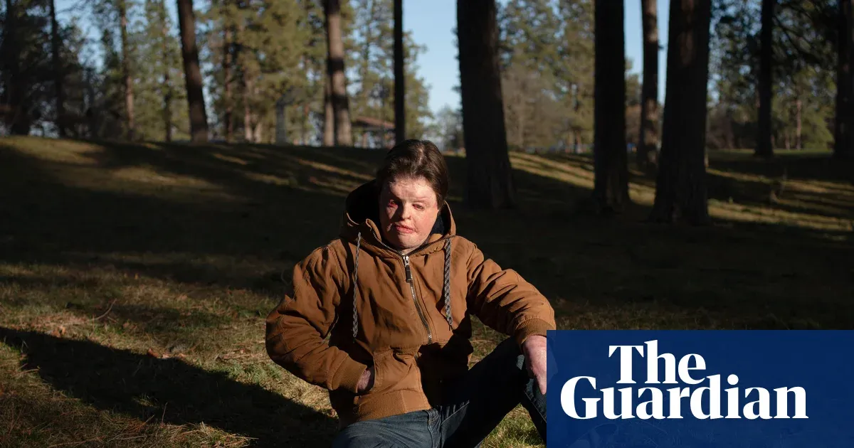 I suffered terrible burns as a child – then became a firefighter — Lifestyle | The Guardian