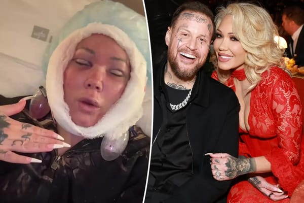 Bunnie Xo unveils gruesome facelift aftermath — Pagesix